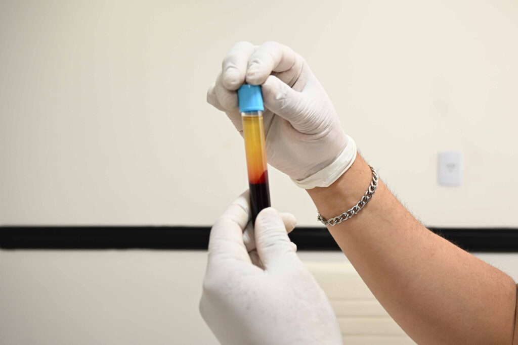 imagen de un tubo de laboratorio conteniendo sangre ya procesada para separar el plasma para uso en dermatología
