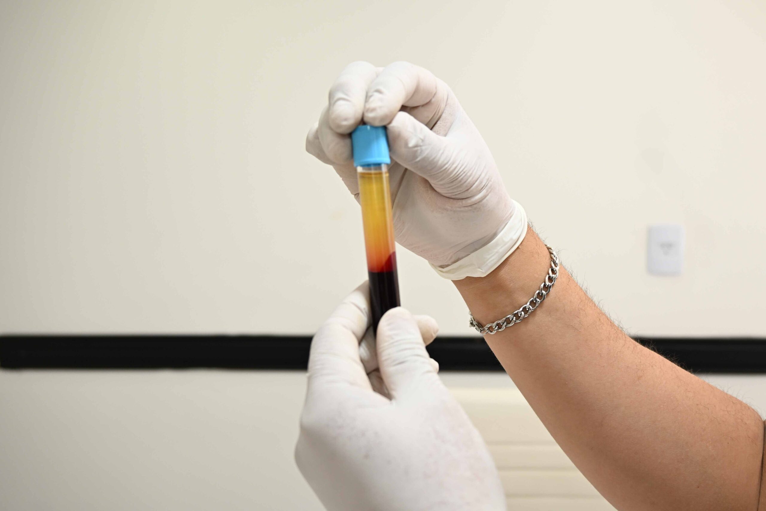 imagen de un tubo de laboratorio conteniendo sangre ya procesada para separar el plasma para uso en dermatología